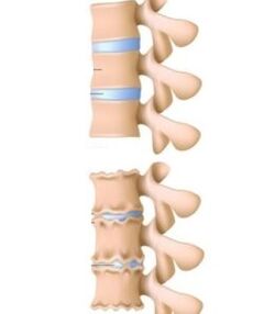 Les causes de l'ostéochondrose