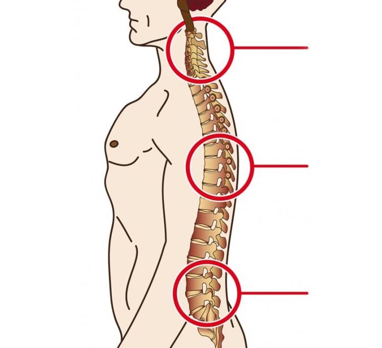 localisation de l'ostéochondrose cervicale, thoracique et lombaire