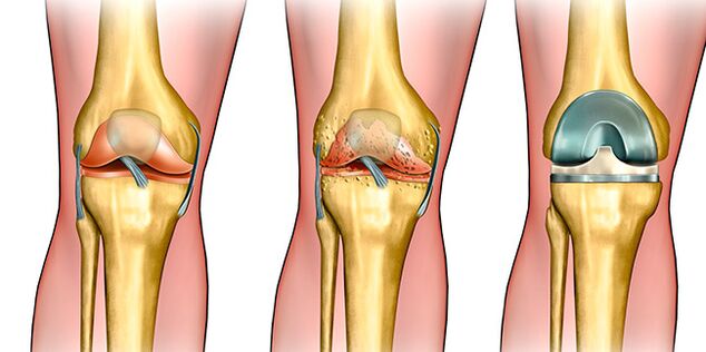 Au troisième stade de l'arthrose, une arthroplastie du genou est nécessaire