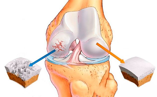 Une articulation du genou normale (à droite) et une atteinte d'arthrose (à gauche)