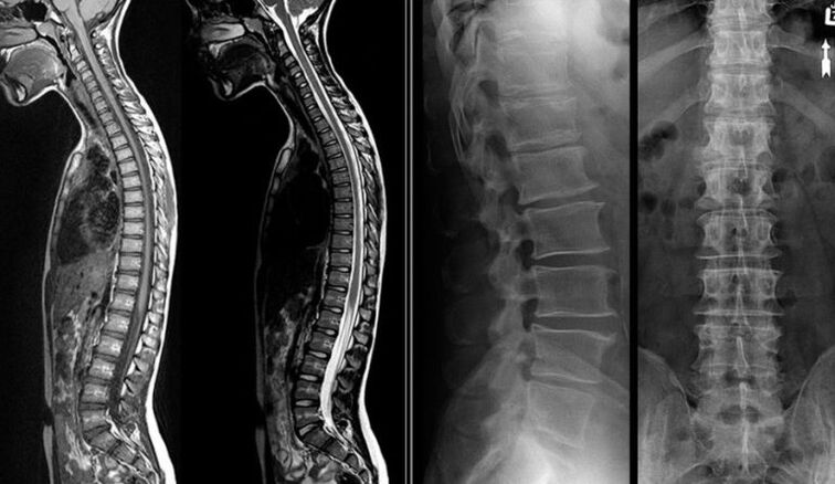 Images radiographiques et IRM pour l'ostéochondrose