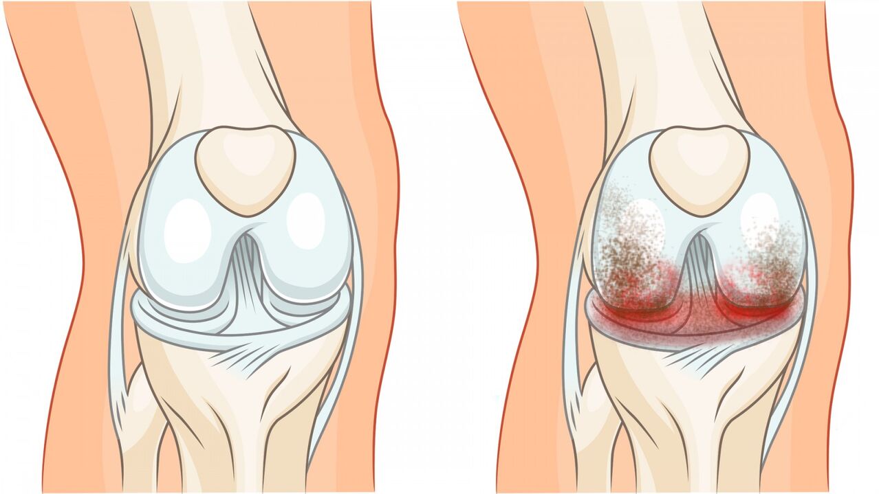 articulation saine et arthrose de l'articulation du genou