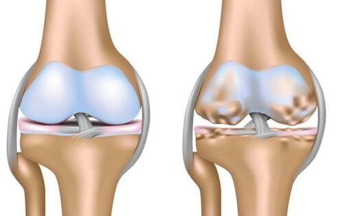 articulation saine et destruction de l'articulation du genou dans l'arthrose