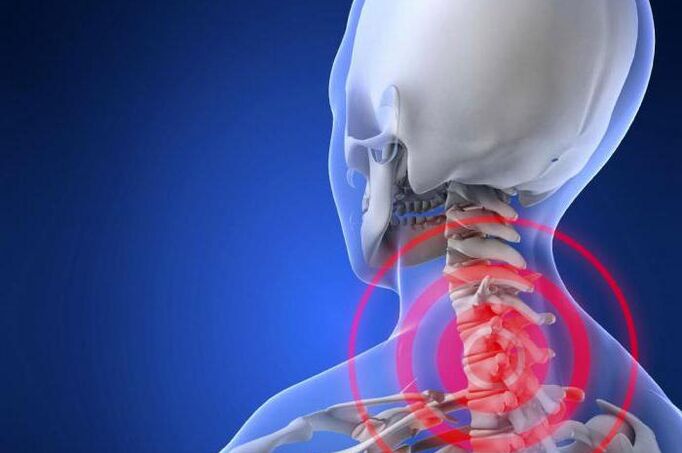 Douleur lancinante dans le cou - un symptôme précoce de l'ostéochondrose cervicale