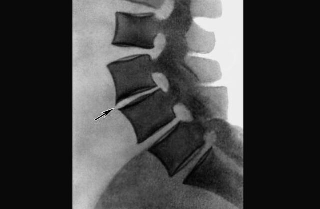 Manifestations d'ostéochondrose du rachis thoracique sur la radiographie