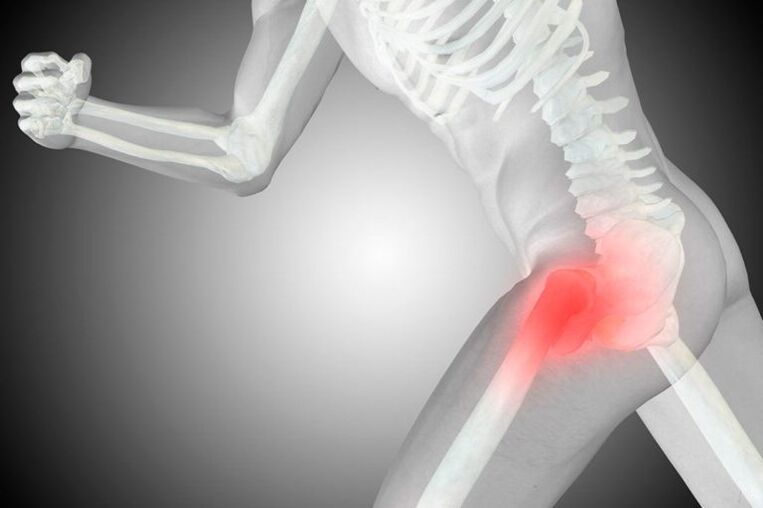 Coxarthrose de l'articulation de la hanche