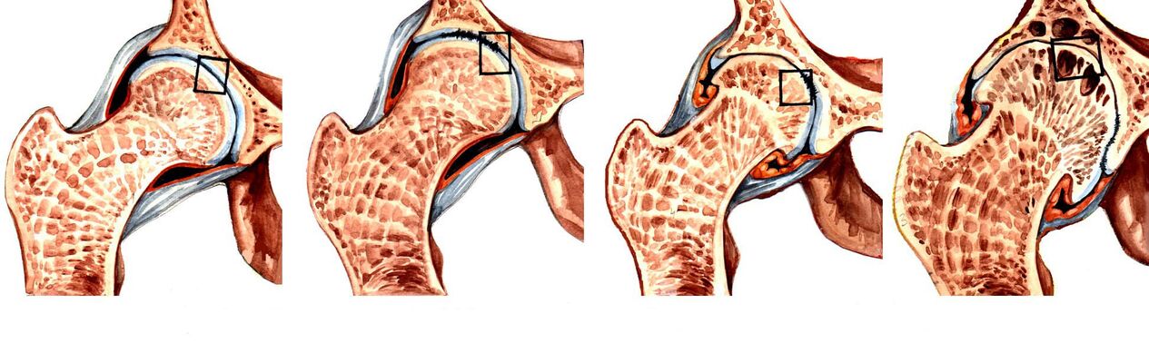 Degrés de coxarthrose déformante