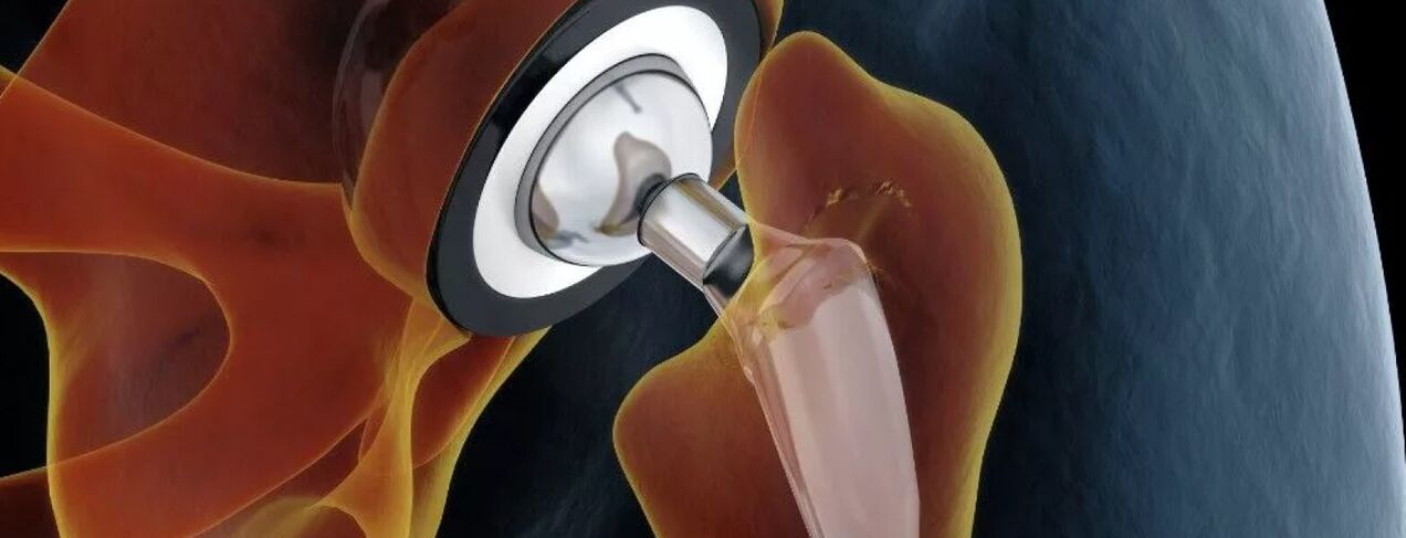 Endoprothèses de l'articulation de la hanche dans la coxarthrose du dernier degré