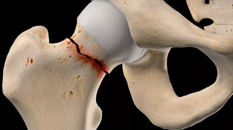 La fracture du col fémoral est une des causes de coxarthrose secondaire. 