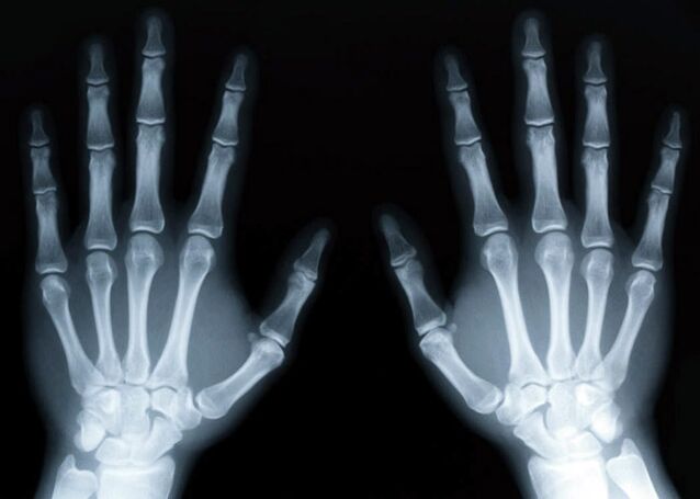 La goutte provoque le développement d'une arthrite goutteuse, qui peut être diagnostiquée par radiographie